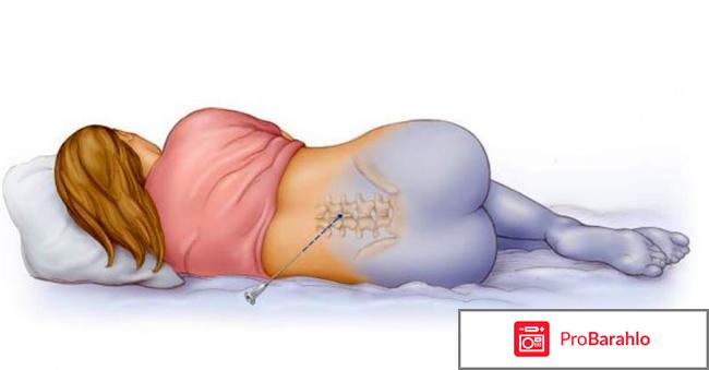 Эпидуральная анестезия при кесаревом сечении отрицательные отзывы