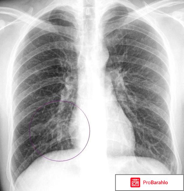 Воспаление легких симптомы 