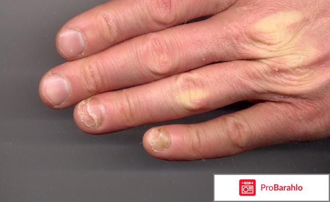 Тербинофиновая мазь инструкция цена отзывы обман