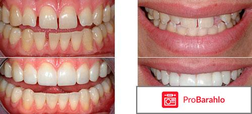 Эстетическая реставрация зубов 