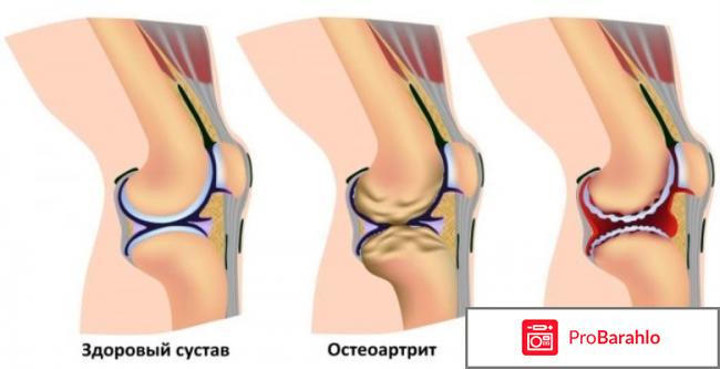 Артра для чего 