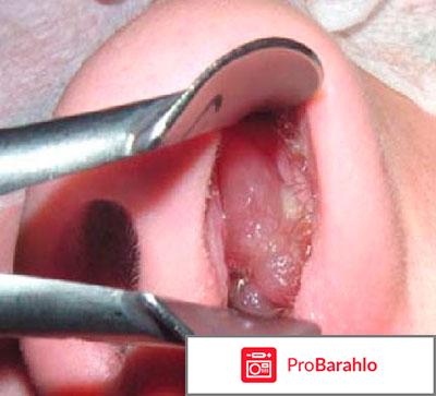 Из носа течет желтая жидкость что это обман