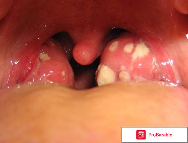 Как вылечить гнойную ангину 