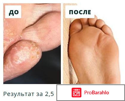 Сангридок спрей от грибка - развод или нет? фото