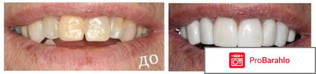 Накладки на зубы 