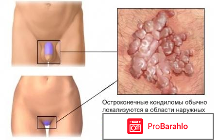 Кондиломы у женщин отзывы 