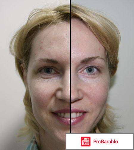 Ботокс фото 