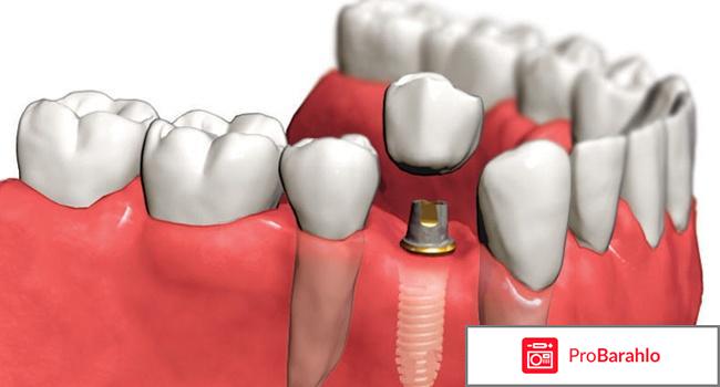 Имплантация зубов отзывы пациентов форум 2017 обман