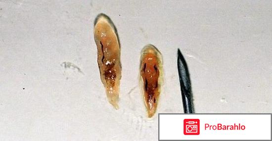 Описторхоз симптомы 