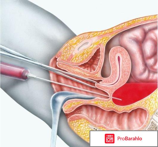 Гистероскопия удаление полипа 