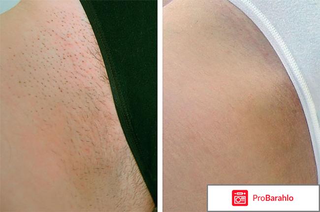 Шугаринг бикини отзыв отрицательные отзывы