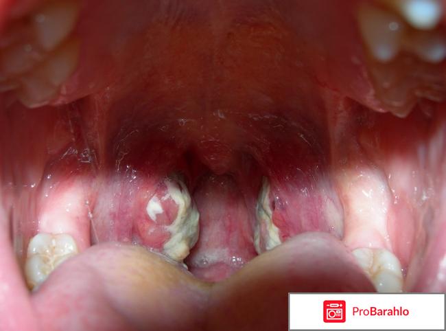 Гнойная ангина чем лечить обман