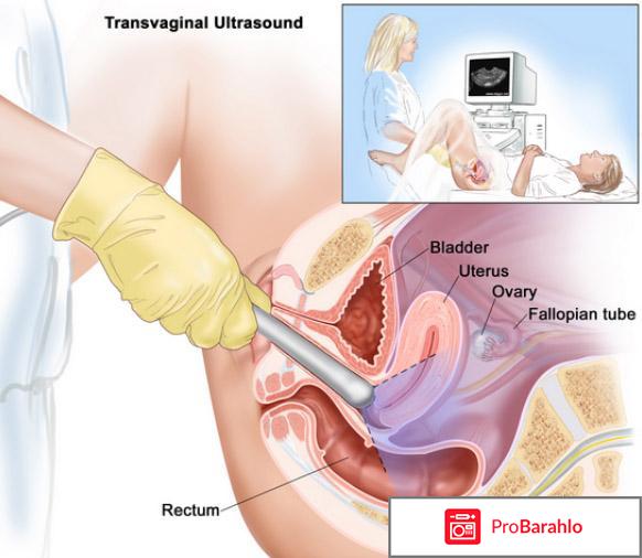 Как подготовиться к узи матки и придатков обман