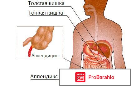 Виды аппендицита 