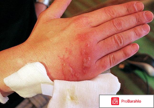 Чем мазать ожог 