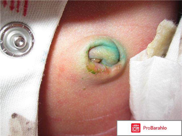 Пупок мокнущий 