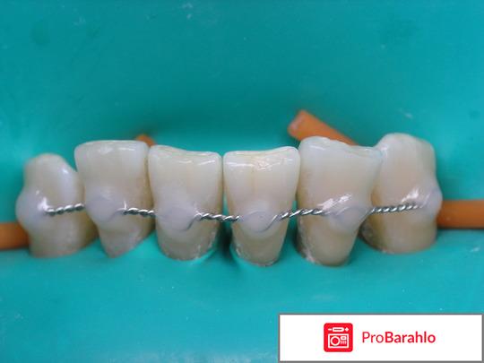 Шинирование зубов отзывы пациентов