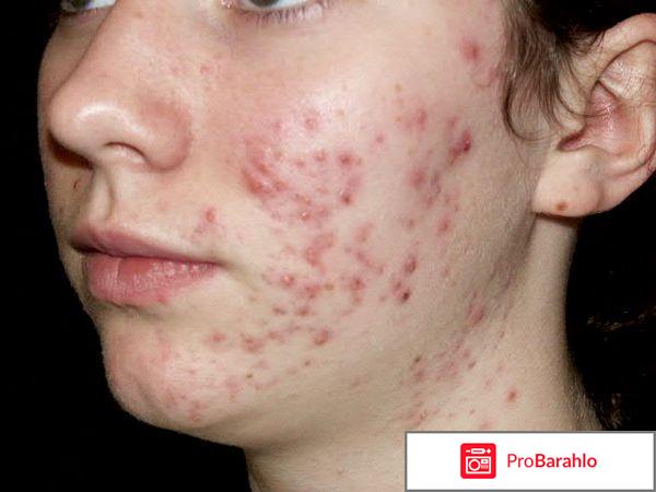 Причины появления прыщей 
