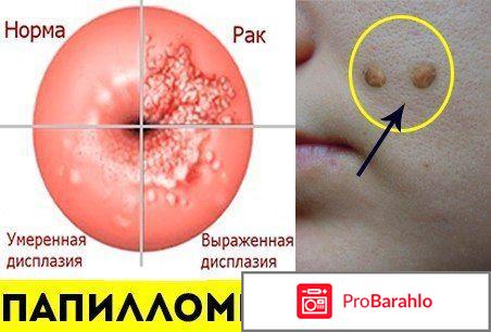 Клареол лекарство от папиллом цена отзывы 