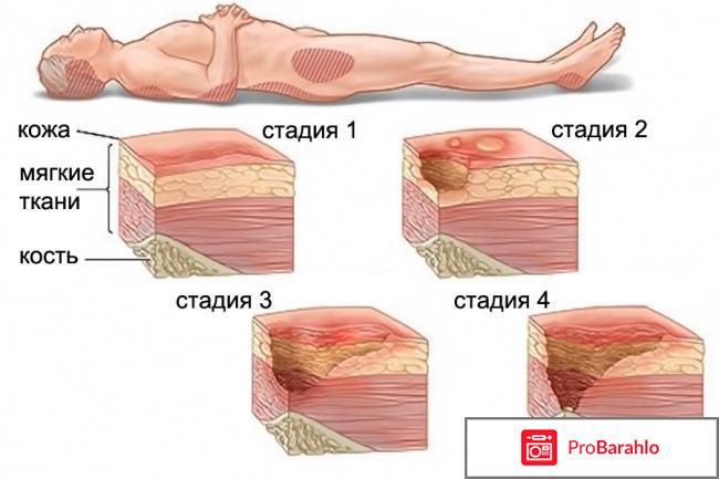 Противопролежневый матрас с компрессором 