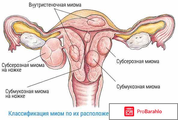 Лапароскопия миомы матки послеоперационный период реальные отзывы отрицательные отзывы