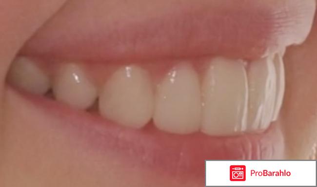 Реставрация передних зубов 