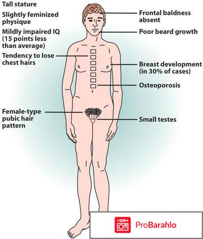 Синдром клайнфельтера фото обман