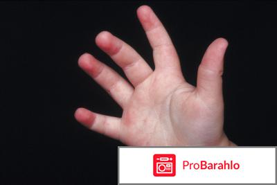 Сыпь на ладошках и ступнях у ребенка отрицательные отзывы