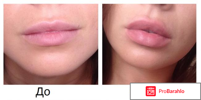 Тренажер для увеличения губ Sexy lips 