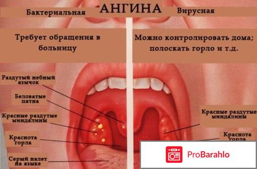 Признаки ангины у детей отрицательные отзывы