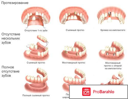 Какие бывают протезы 