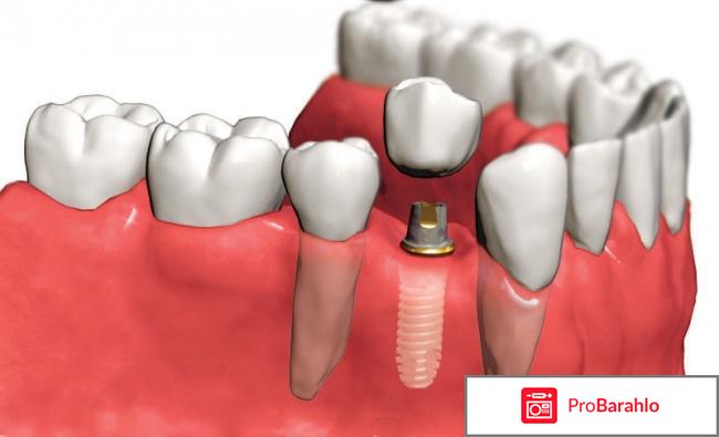 Имплантация зубов в спб отзывы 