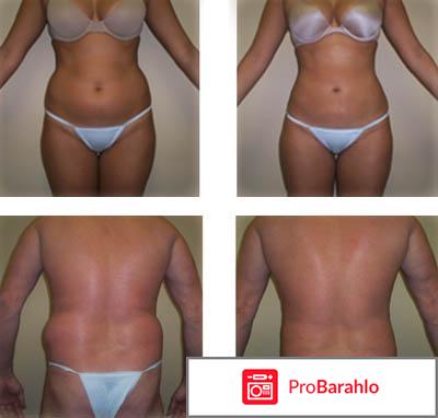 Инъекции для похудения отзывы обман