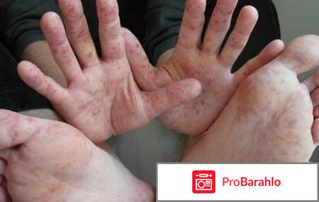 Вирус Коксаки в Турции 2017. Какие последние новости? В каких отелях? 