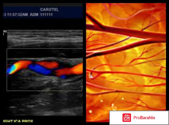 Узи брахиоцефальных сосудов 