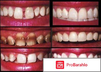 Виниры на зубы фото отзывы обман