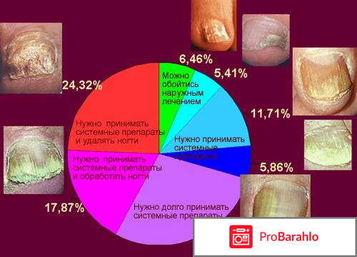 Фото грибка ногтей на ногах 