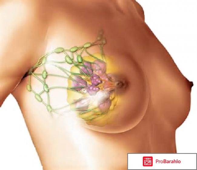 Мастодинон отзывы женщин при мастопатии таблетки форум 