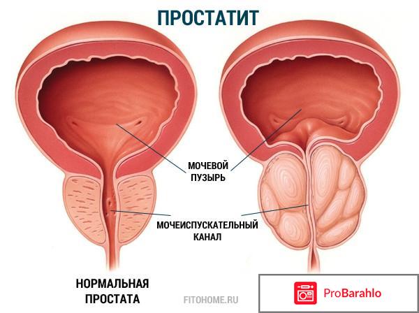 Лечение простатита народными средствами самые эффективные отзывы отрицательные отзывы