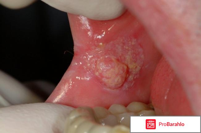 Папиллом отзывы врачей обман