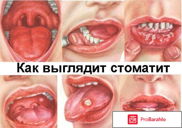 Язва во рту: Лечение в домашних условиях отрицательные отзывы