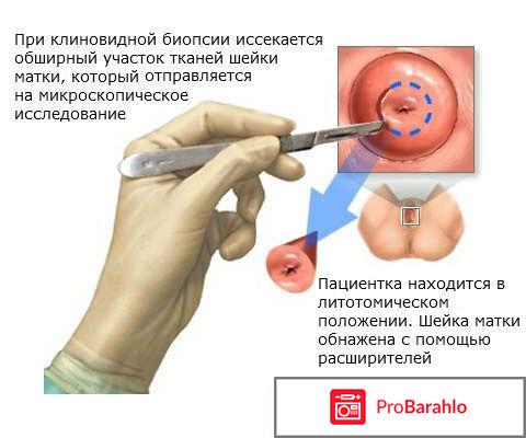 Биопсия шейки матки при эрозии 