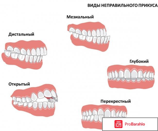 Исправление прикуса брекетами 