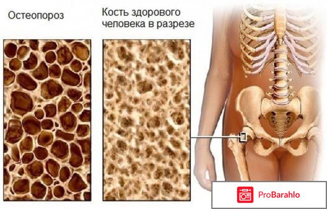 Профилактика остеопороза обман