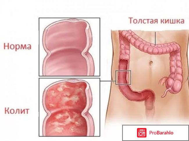 Колит 