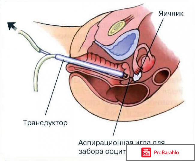 Ооциты отрицательные отзывы