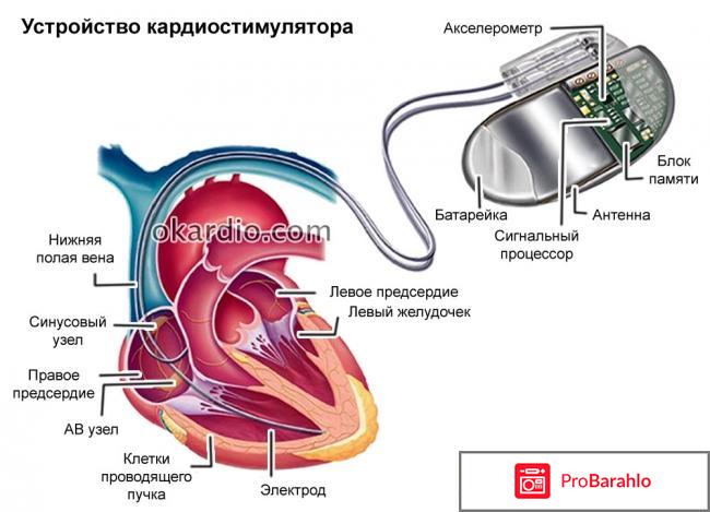 В каких случаях ставят кардиостимулятор на сердце 