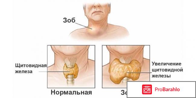 Щитовидная железа: симптомы заболевания у мужчин обман