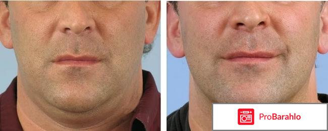 Липолитики для подбородка отзывы отрицательные отзывы