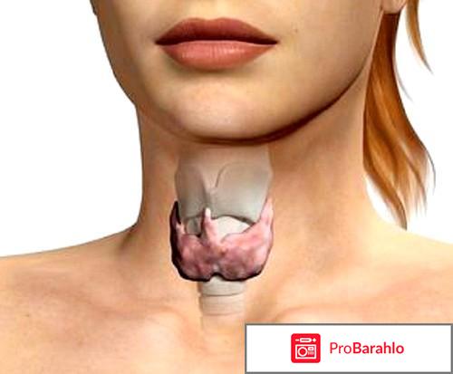 Щитовидная железа лечение 